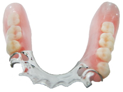 Cast Partial Denture